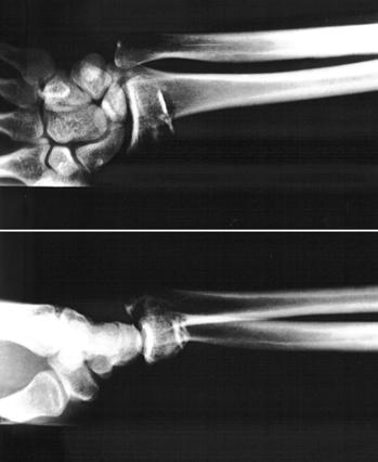 Figura 4 - Fotografia do foco de fratura. Detalhe da comimuição. Figure 4 - Photograph of the fracture. See multi-fragmentation.