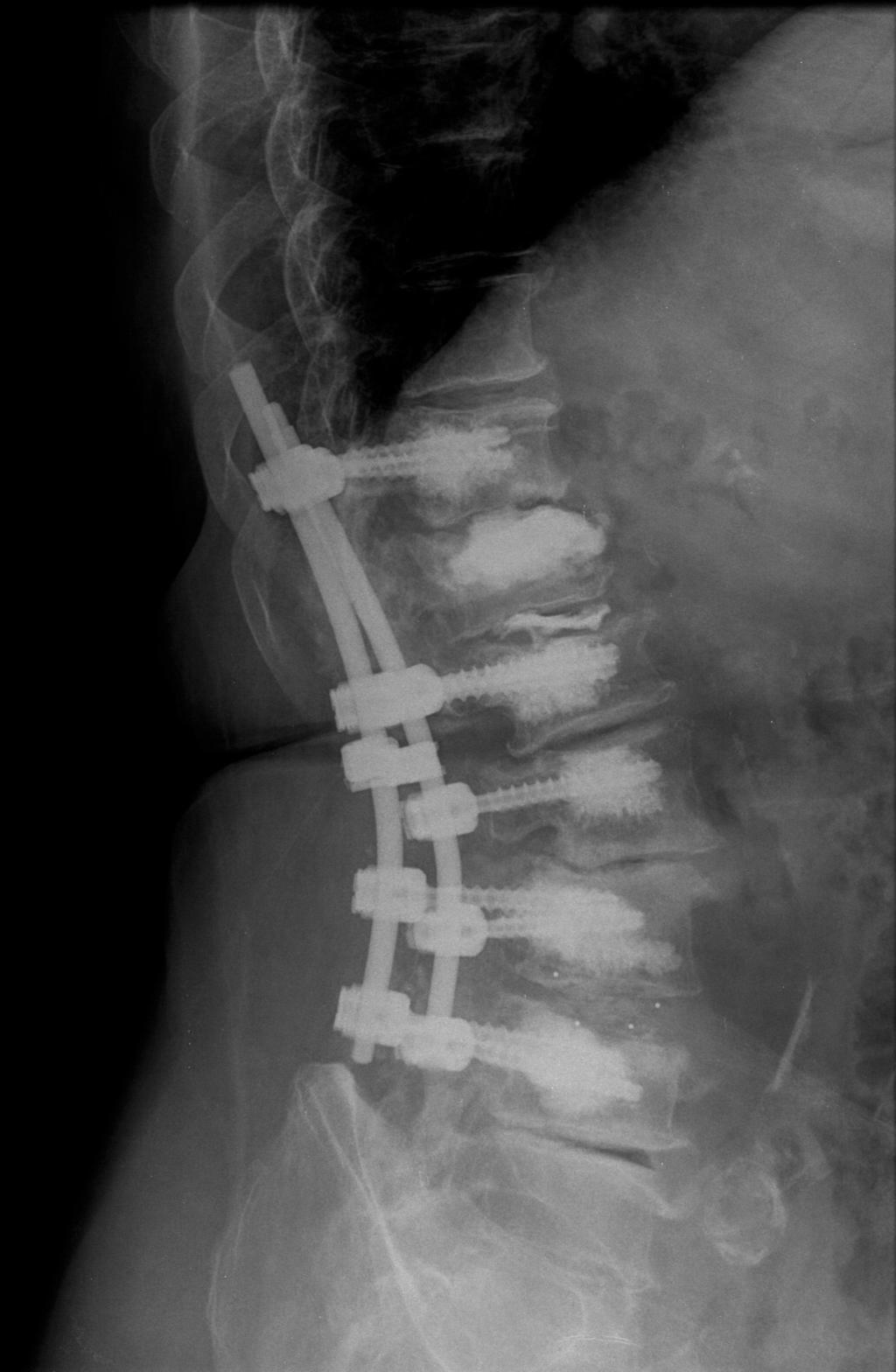 CIRURGIA DE REVISÃO NA ESTENOSE DO CANAL LOMBAR A B Fig.