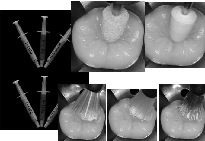 Polimerização Ajustes oclusais Acabamento