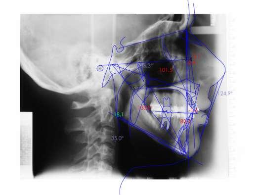 53 Co A: em milímetros, foi observado o comprimento da maxila; Co-Gn: em milímetros, foi obervado o comprimento da mandíbula; Plano mandibular: em graus, foi observado a inclinação da mandíbula em