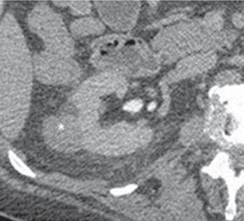 de investigação da lesão, posteriormente confirmada com carcinoma de células claras. C Figura 8. RM e imagem por difusão (DWI).