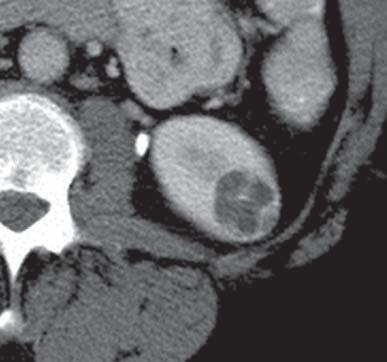 Carcinoma renal de células claras, cístico, confirmado após exérese.