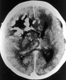 TC e RM nos oligodendrogliomas: correlação clínica e patológica Ao todo, foram revistos 24 casos, sendo que o exame pré-operatório disponível em 18 casos era apenas a tomografia computadorizada (TC),