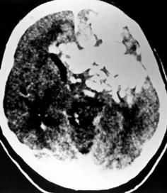 Simão MN et al A B C Figura 2 Oligoastrocitoma anaplásico A,B: Cortes de tomografia computadorizada sem e com contraste