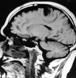 correlações em nossa casuística Os resultados encontrados indicando que o oligodendroglioma é um tumor que acomete mais