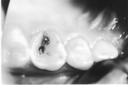 8 (1995), com o advento dos materiais adesivos, as possibilidades de grandes reconstruções dentárias aumentaram, oferecendo ao cirurgião-dentista, uma maior possibilidade de conservação das