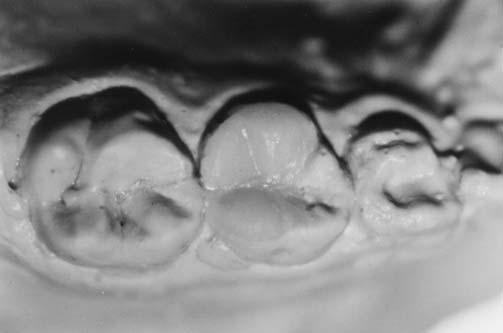 Figura 4 - Inserção da resina composta em incrementos não maiores que 2mm e subseqüente fotopolimerização. Observar a definição da anatomia oclusal.