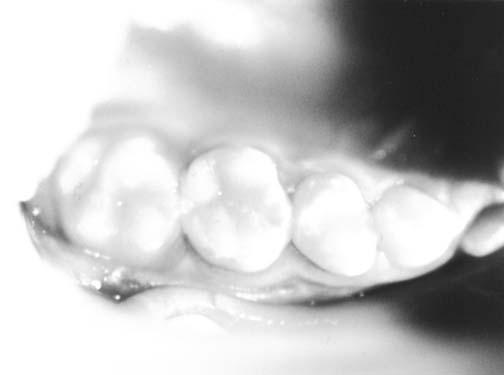 10 proximais dos dentes adjacentes, evitando, assim, a- desão entre essas superfícies. Remoção dos excessos marginais cervicais e fotopolimerização final em cada face do dente.