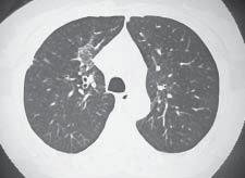 Compartimento axial 8 15 5 Compartimento periférico Diagrama 2 - Distribuição das lesões de acordo com os compartimentos pulmonares.