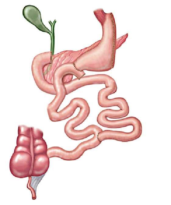 (3) Deve ser evitada em pacientes obesos mórbidos que têm doença do refluxo gastroesofágico.