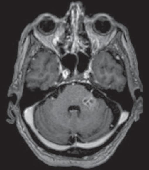 Necrose secundária a radiação no sistema nervoso central (SNC) é um efeito adverso grave incomum da radioterapia, que geralmente se desenvolve de um a três anos após o tratamento (5).