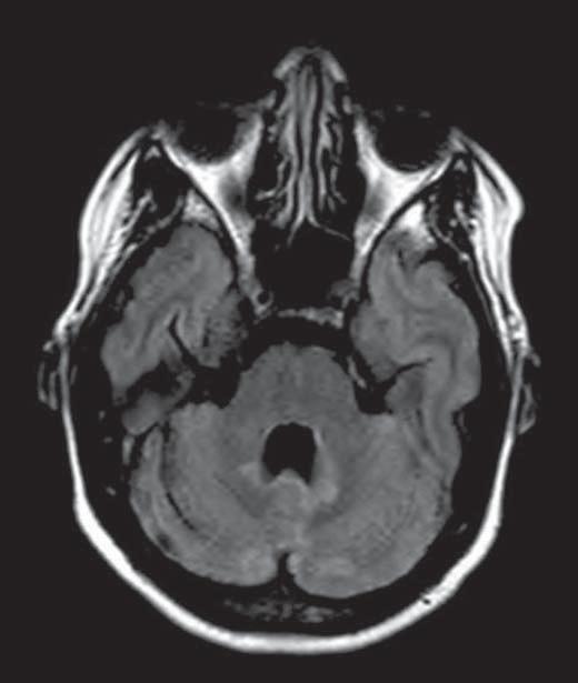 bilateralmente ponte e os pedúnculos cerebelares, sem significativo efeito de massa. Figura 5. Neuro-ehçet.