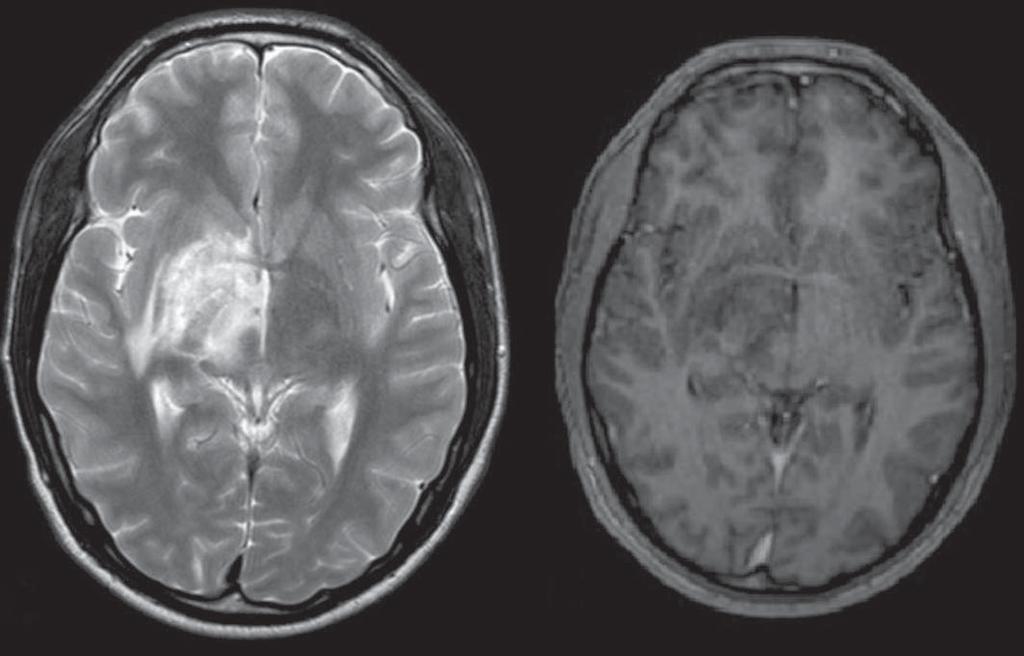 Figura 6. Neuro-ehçet.