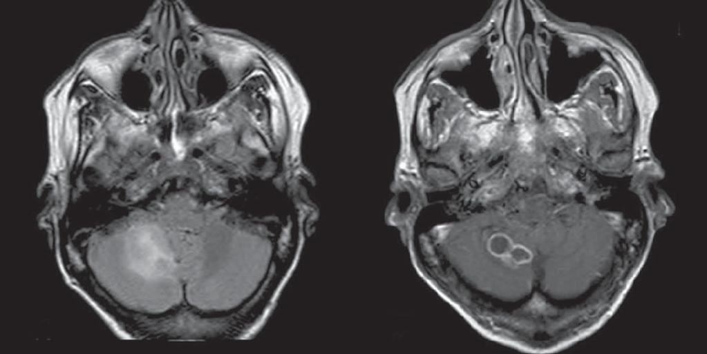 Paracoccidioidomicose apresentação mais comum é a presença de lesões arredondadas ou lobuladas múltiplas, predominantemente hipointensas nas imagens ponderadas em T2, e com realce anelar ou nodular