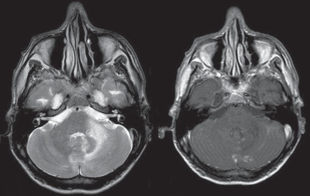 Figura 9. Tuberculose. : RM axial FLIR mostra lesões com edema vasogênico.