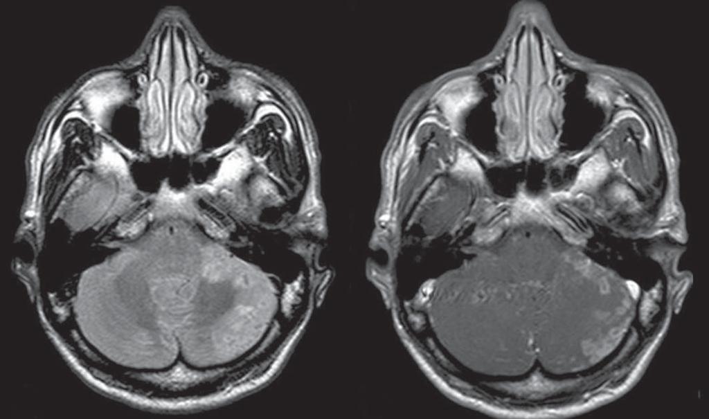 leptomeníngeo. Figura 10. Leucoencefalopatia multifocal progressiva.