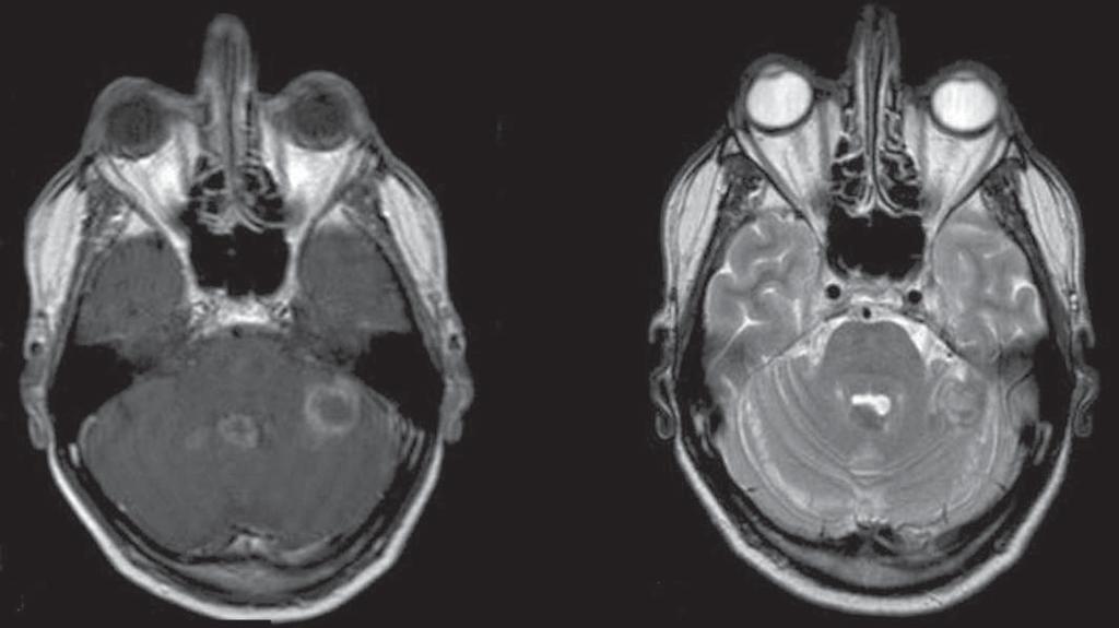 Lúpus eritematoso sistêmico Os achados de RM são diversos, e sinais de atrofia e hiperintensidade de sinal na substância branca muitas vezes se correlacionam pobremente