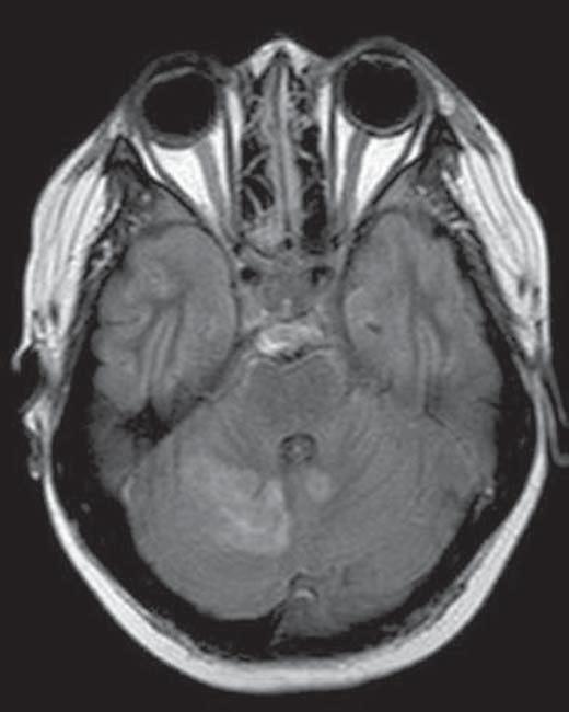 RM axial FLIR axial demonstra múltiplas lesões com sinal intermediário nos dois hemisférios do cerebelo, principalmente à direita, que mostraram restrição à difusão das