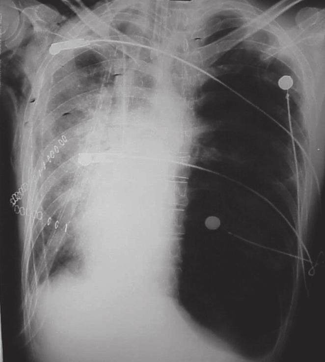 266 Samano MN, Junqueira JJM, Teixeira RHOB, Caramori ML, Pêgo-Fernandes PM, Jatene FB compressão, restrição e distúrbios ventilatórios no pulmão transplantado.