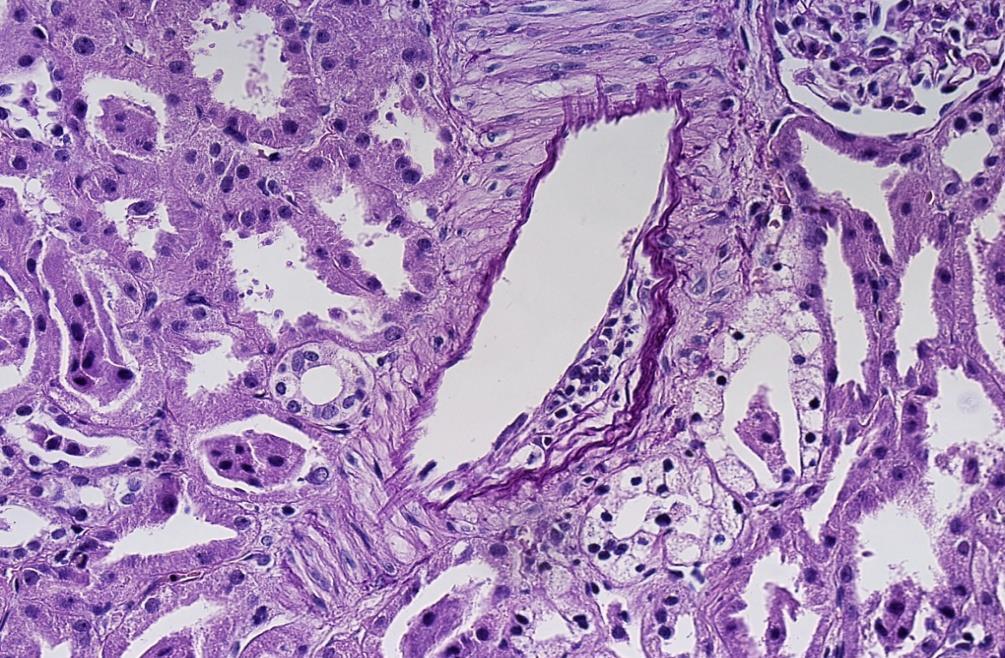 Rejeição vascular Tipo 2 (Banff 2A) Imagem