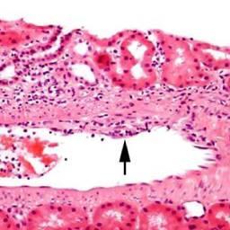 Lesão vascular isolada Intimite com inflamação túbulo-intersticial mínima (menor ou igual a 25%) e tubulites mínimas (tubulites