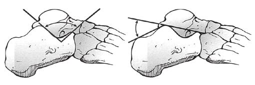 Fratura intra-articular do calcâneo: correlação entre os ângulos de Böhler e Gissane com a classificação tomográfica de Sanders 97 INTRODUÇÃO O calcâneo é o osso mais comumente fraturado entre os