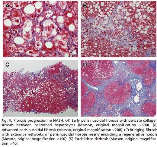 Biópsia hepática: fibrose Essencial para o diagnóstico de NASH: subtipo da DHGNA caracterizado por balonização de hepatócitos na zona 3, esteatose,