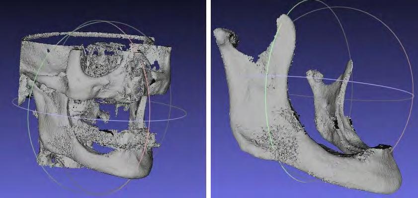 Tendo-se os arquivos da tomografia computadorizada pode-se gerar a imagem tridimensional pelo software Invesalius como ilustrado na figura 1.