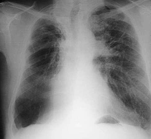 pulmonar) Colapso