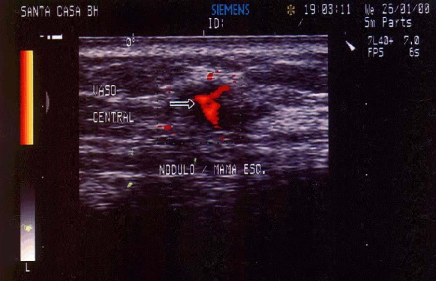 84 FIGURA 6: Representação ilustrativa de uma lesão nodular com padrão de vascularização central ao Doppler. 4.5.