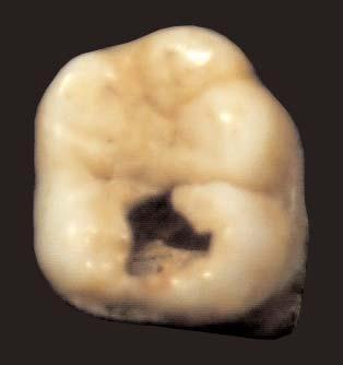 Na opinião de LANGSJOEN (1998), este tipo de perda não só reduz materialmente a função mastigadora como cria malformações, pois os dentes que permanecem tendem a inclinar-se, mover-se, rodar ou a
