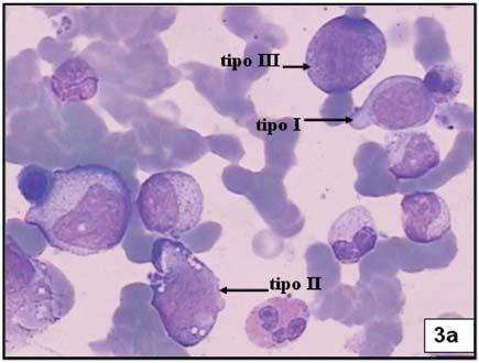 Rev. bras. hematol. hemoter. 2006;28(3):167-174 Niero-Melo L et al Figura 5. Dismegacariocitopoese.