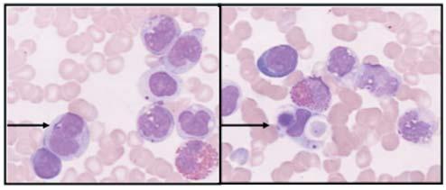 Observar assincronismo maturativo entre núcleo-citoplasma nas outras células granulocíticas Figura 3b). Mieloblastos atípicos.