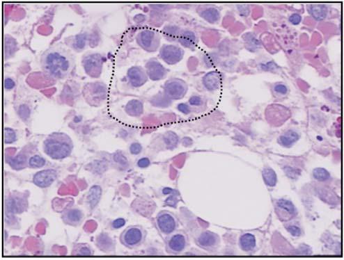 Niero-Melo L et al Rev. bras. hematol. hemoter. 2006;28(3):167-174 e não são vistos megacariócitos em número de 10 ou mais.