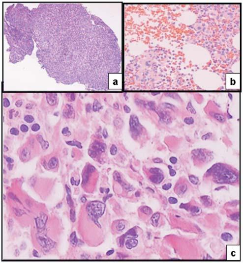 Devemos diferenciar microformas de megacarioblastos Em relação às alterações histológicas da MO, 7-9 recomendamos os ítens abaixo: fragmento de crista ilíaca posterior (ou anterior).