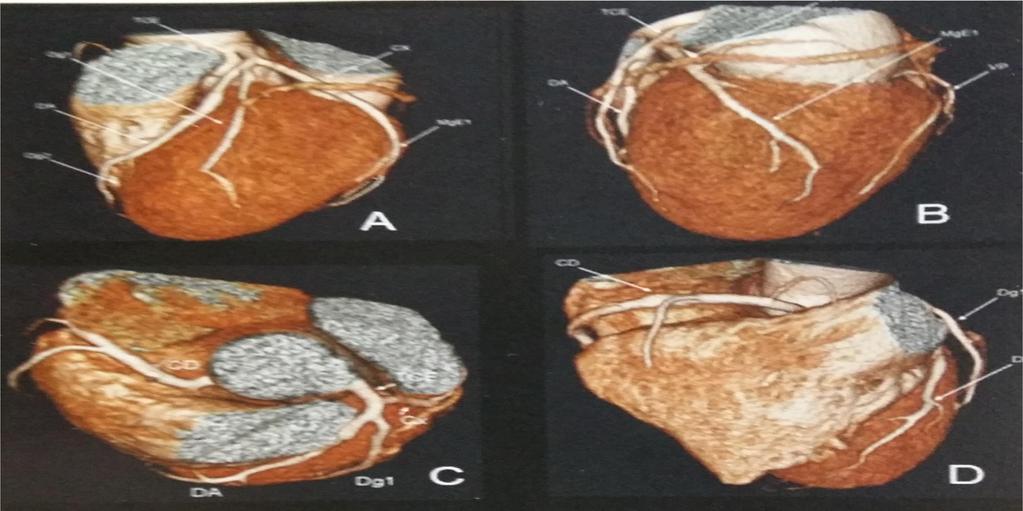 18 mm em seu diâmetro e é a artéria circunflexa que assumirá o trajeto do posterior no atrioventricular.