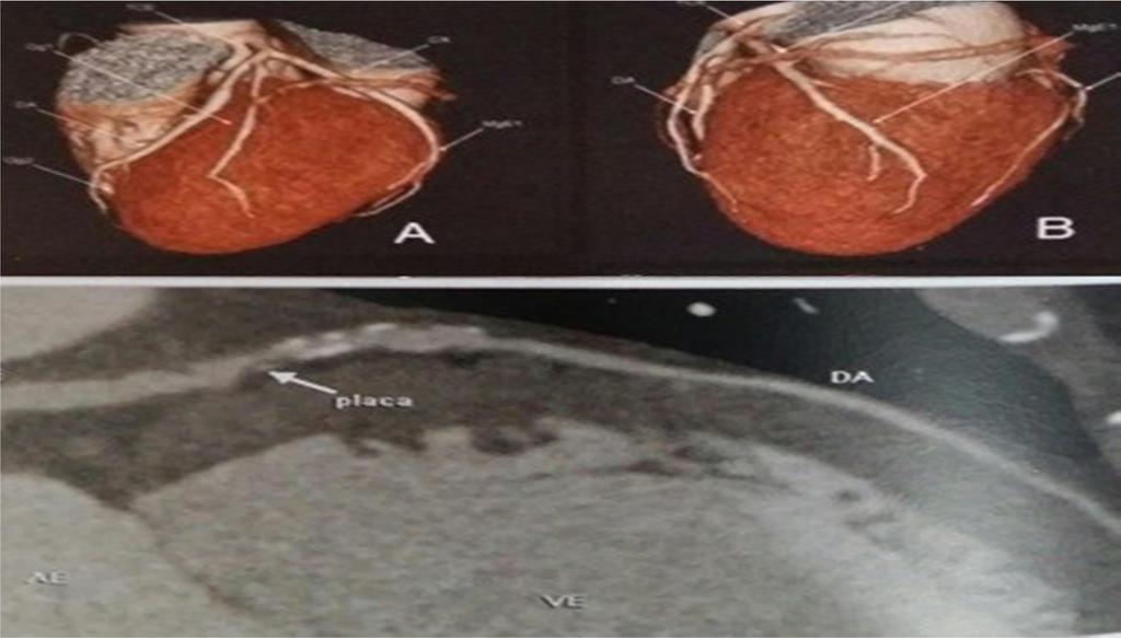 21 Figura 5: Reconstrução em 3D do coração (A: vista anterior; B: vista lateral esquerda) e reformatação multiplanar com presença de placa mista na artéria coronária descendente anterior.