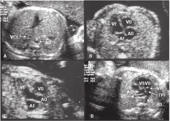 306 Carvalho SRM, Mendes MC, Cavalli RC, Machado JC, Duarte G, Berezowski AT Figura 1 - Número e porcentagem dos diferentes fatores para indicação do ecocardiograma fetal.