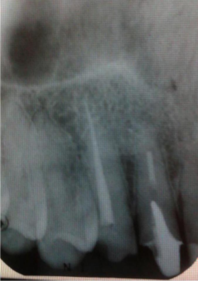 fotoativadora ao longo do canal radicular e pelo desenho e adequação do pino1. As falhas de pinos e coroas podem ser o resultado de fratura do pino e do remanescente dentário ou a sua soltura.