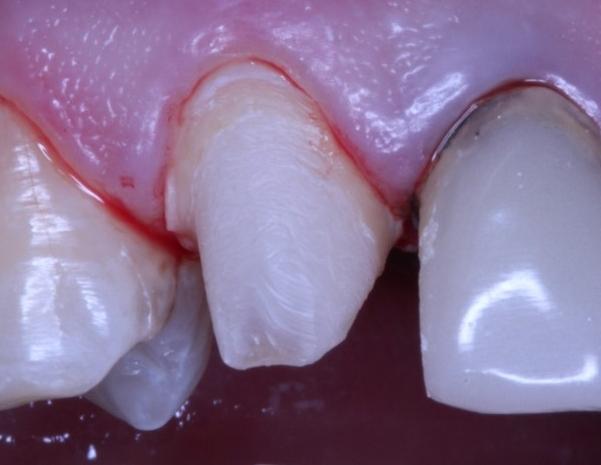 onado o preparo para coroa total estética (Figura 7), o provisório foi reembasado e cimentado com cimento RelyX Temp (Figura 8). Figura 6.