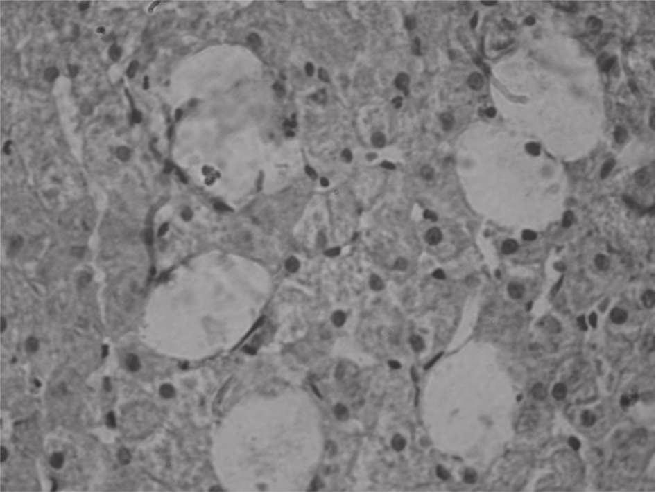 (M1) INTENSIDADE GRANULAÇÃO VACUOLIZAÇÃO DIMENSÃO M0 M1 M0 M1 M0 M1 Discreta 85.7% 80% 85.7% 60% 57.1% 40% Moderada 14.3% 20% 14.3% 40% 28.6% 40% Intensa - - - - 14.3% 20% Tabela 3.