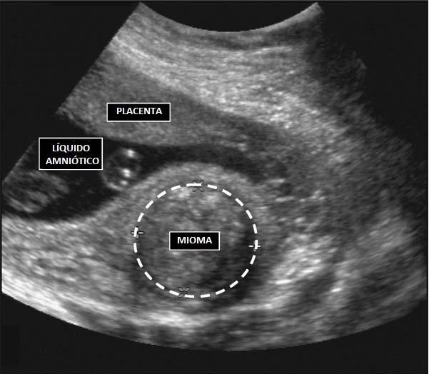32 Introdução Os leiomiomas uterinos são os tumores benignos que mais acometem as mulheres 1.