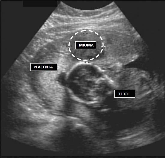 34 assimetria ventricular, entre outras, em fetos com cariótipo normal 1.