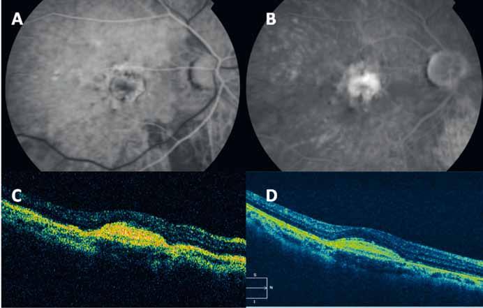 Ranibizumab no Tratamento da Neovascularização Coroideia Secundária a Miopia Patológica: 24 Meses De Follow-Up Quadro 3 Melhor acuidade visual corrigida (MAVC) em LogMAR, em letras ETDRS, espessura