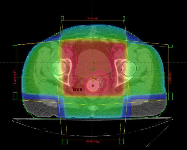 Conclusões Suprimir radioterapia em pacientes com câncer de corpo de