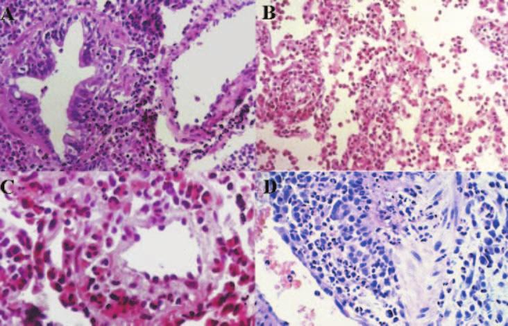 Apresentação anatomopatológica das vasculites pulmonares S 11 Figura 2 - Vasculite granulomatosa não-necrotizante eosinofílica.