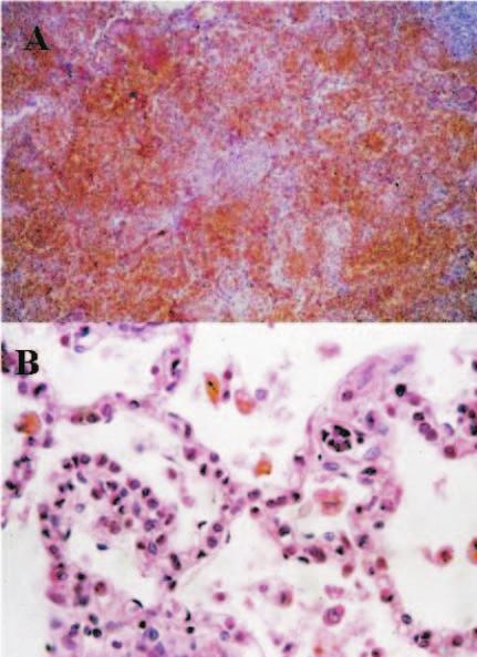 S 12 Capelozzi VL, Parras ER, Ab Saber AM evidencia-se a presença de macrófagos com hemossiderina, bem como a presença de hemácias íntegras.