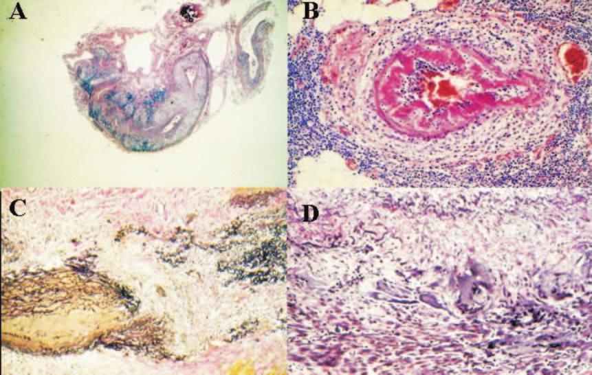 Acúmulo exuberante de neutrófilos ao longo dos septos alveolares caracteriza o quadro de capilarite pulmonar, um dos mais graves do ponto de vista clínico (Figura 4B).