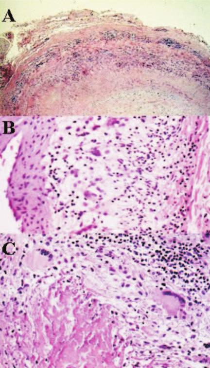 Apresentação anatomopatológica das vasculites pulmonares S 13 tidas, por um substrato morfológico que inclui a necrose fibrinóide da camada média (Figura 5B), associada a uma reação inflamatória a