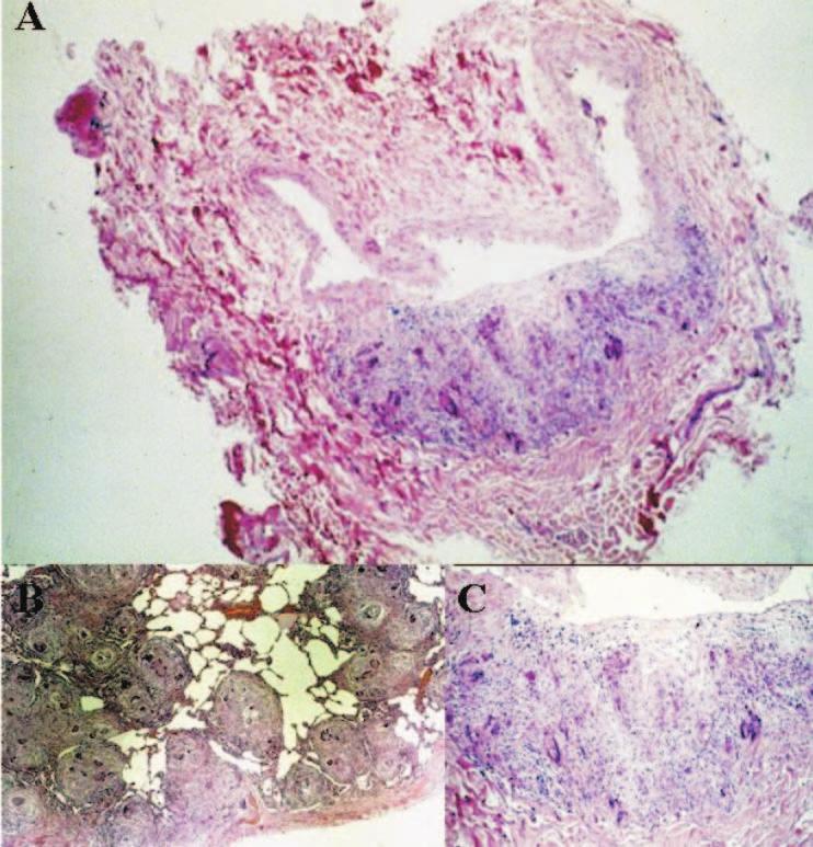 S 14 Capelozzi VL, Parras ER, Ab Saber AM Figura 8 - Diagnóstico histopatológico: arterite necrotizante segmentar em variados estádios de organização em vasos de médio